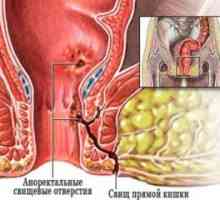 Abces anorectal: tratament, simptomele, cauzele