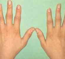 Artrita comun falanga metacarpiană mâinii: tratament, simptome, semne, cauze