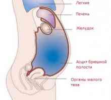 Ascita-peritonită