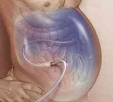 Ascită în cancerul gastric