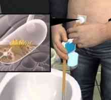 Aspireassist: implant chirurgicale pentru tratamentul obezității