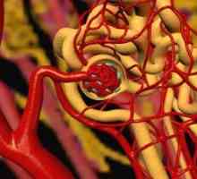 Ateroemboliya arterelor renale