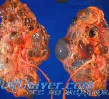 Boala autozomal dominanta de rinichi polichistic la copii. Diagnostic si tratament