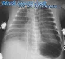 Plămâni barotraumă în timpul decompresie. Patogeneza barotraumă pulmonare