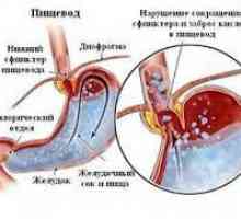 Esofagita de reflux biliar