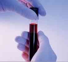 Analiza biochimică a sângelui pentru pancreatită