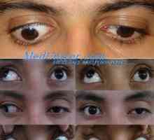 Boala lui Graefe. apraxia oculară congenitală sau sindrom Cogan