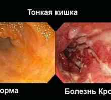 Boala Crohn si colita ulcerativa