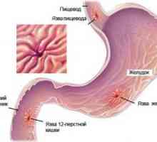 Ulcer duodenal