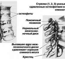 Dureri de spate. spondylarthrosis