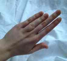 Degetul mare Brachydactyly: cauze, tratament, simptome, semne