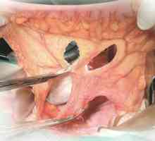 Rezecție abdominală-anală a rectului cu aducerea în jos coajă