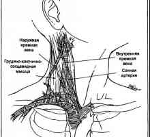 Acces venos central: cateterizarea vena jugulară internă - două acces