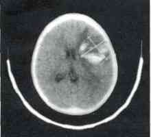 Leziuni cerebrale traumatice la copii. Brain Injury