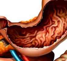 Ce este gastrita anatsidny cronica, simptomele si tratamentul acesteia