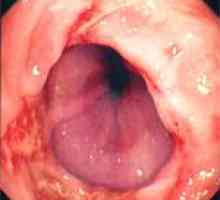 Ce este eritematoasă esofagite reflyuk?