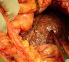 Ciroză pancreasului