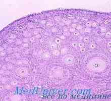 Ovare Meristoma. Tekakletochnaya tumora Tecoma