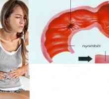 Ddivertikul 12 ulcer duodenal (DU)
