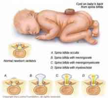 Defecte de tub neural la copii: encephalocele, meningomyelocoele