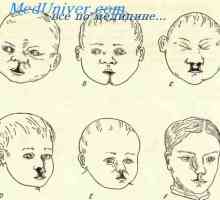 Defecte în dezvoltarea fețelor embrionului. Defecte în fălcile de fetus