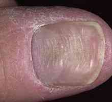 Deformarea unghiilor: cauze, tratament