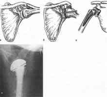 Deformând artroza articulațiilor membrului superior