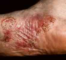 Dermatita a mâinilor și picioarelor
