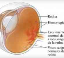 Retinopatie diabetică neproliferativă și retinopatia diabetică (RDNP)