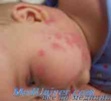 Diagnosticul de alergie și alte efecte secundare ale medicamentelor la copii