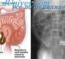 Obstrucție gastro-intestinale. Gaze din flatulență tractului gastro-intestinal