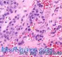 Diagnosticul de cancer tiroidian