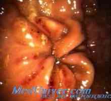 Disfuncții ale sistemului hipofizo-suprarenale in boala ulcer peptic