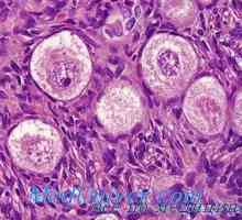 Seminom Disgerminoma sau ovare. Lipoidnokletochnye virilizare tumori ovariene