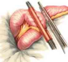 Intestin diverticuloza (colon): tratament, simptome, diagnostic
