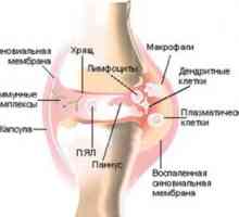 Dysenteric (posledizenteriyny) artrita