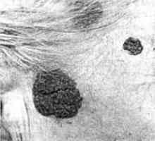 Tumorile benigne ale pielii, capului și gâtului: nev pigmentat