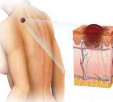 Tumorile benigne ale pielii: tipuri, clasificare, tratament, simptome