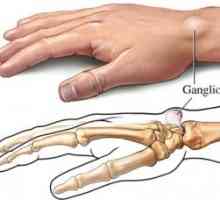 Tumorile benigne ale țesuturilor moi ale mâinii: tratament, cauze, simptome, semne
