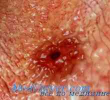 Dock in boala ulcer peptic. Efectul ulcerului gastric mineralocorticoizi