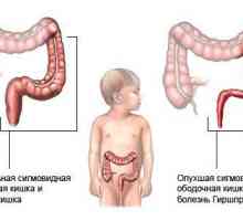 Dolichosigma intestinale la copii