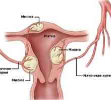 Fibrom uterin, tratament, simptome, semne, cauze