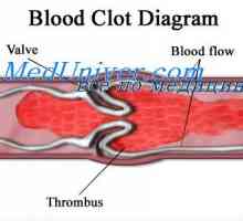 Inițiere totală de coagulare a sângelui. anticoagulante intravasculare