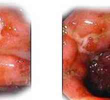 Forme și stadii ale bolii Crohn