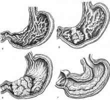 Forme de cancer la stomac, sindroame raznovvidnosti, marimea, localizarea