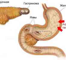 Gastrinom pancreasului