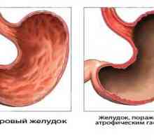 Gastrita și cancerul gastric