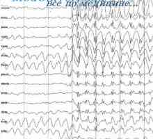 Care sunt cauzele si se opreste convulsii mari de epilepsie? Malaya epilepsie