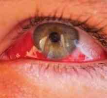 Hemoftalm tratament ochi, cauze, simptome de clasificare,