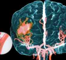 Hemogoagulatorii cerebrale accident vascular cerebral, tratament, simptome, cauze